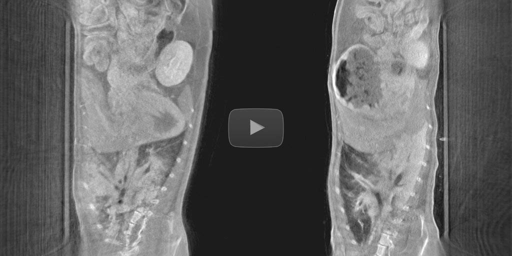 Breath cycle detection directly on input views