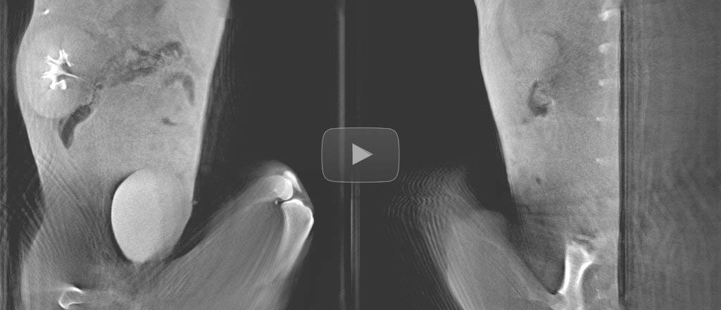 Breathing cycle detection on abdominal scans