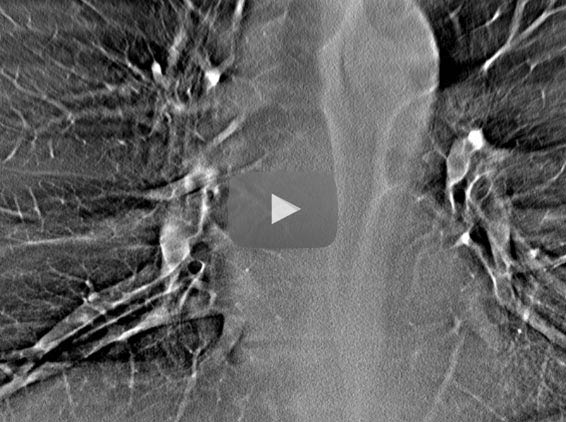 Tomosynthesis Reconstruction of Thorax