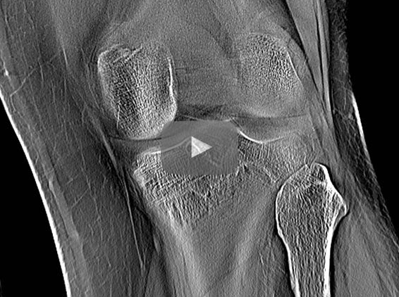 Tomosynthesis Reconstruction of Knee