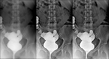 Pelvis_AP