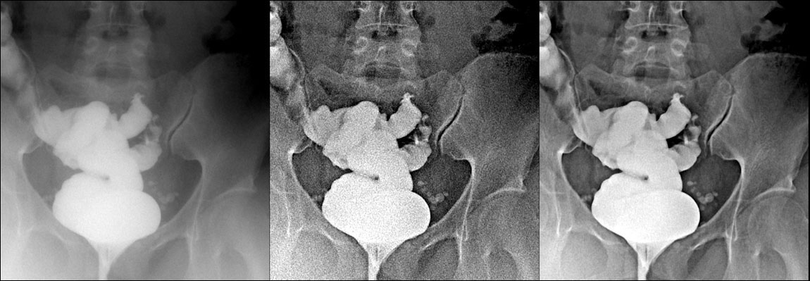 pelvis coronal contrast