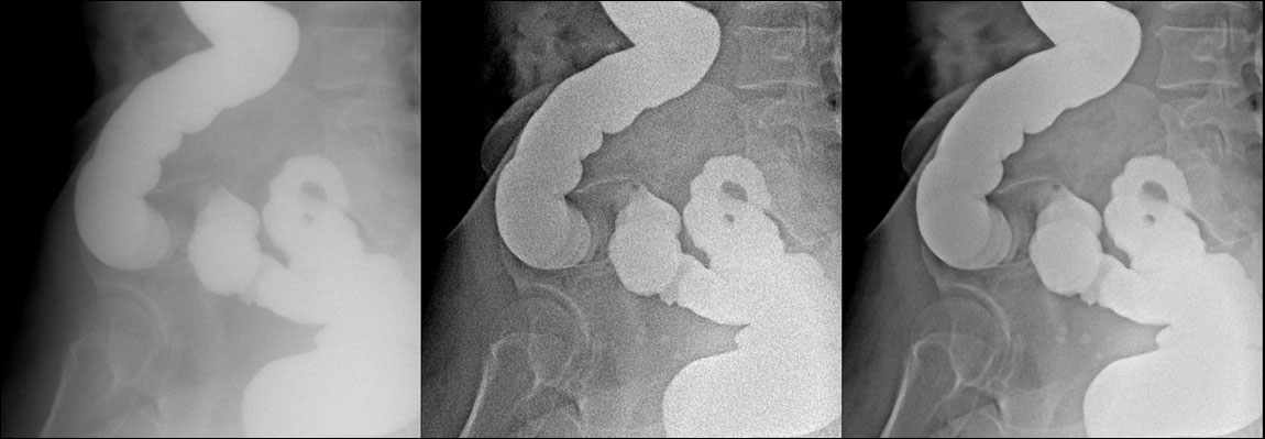 pelvis lateral contrast