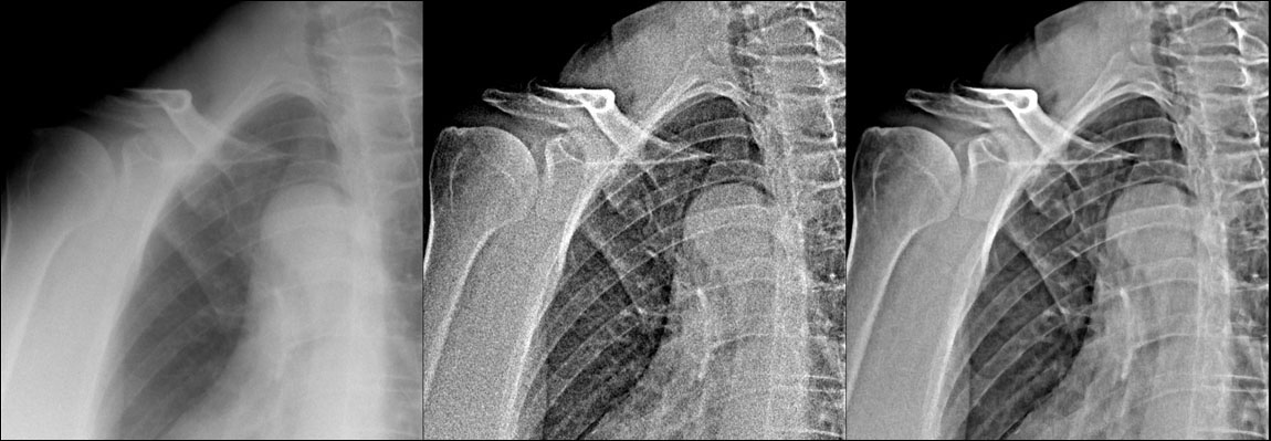 thorax contrast